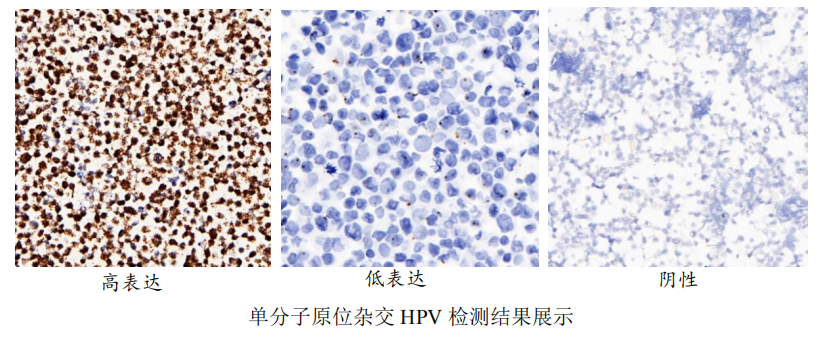 单分子原位杂交HPV822-331.png